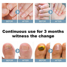 Load image into Gallery viewer, Nail Fungus Cleaning Light Device for Onychomycosis USB Charge 905nm Infrared Light 470nm Blue Light NailSalon Nail Fungus Laser