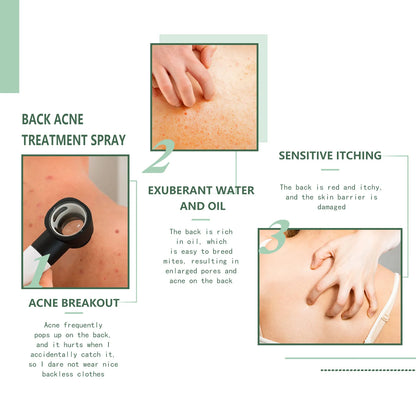 Jaysuing Repair Back Acne Care Spray Shoulder Pimple Remove Fade Acne Scar Soothe Body Nourish Skin Cleansing Body Pimples Spray