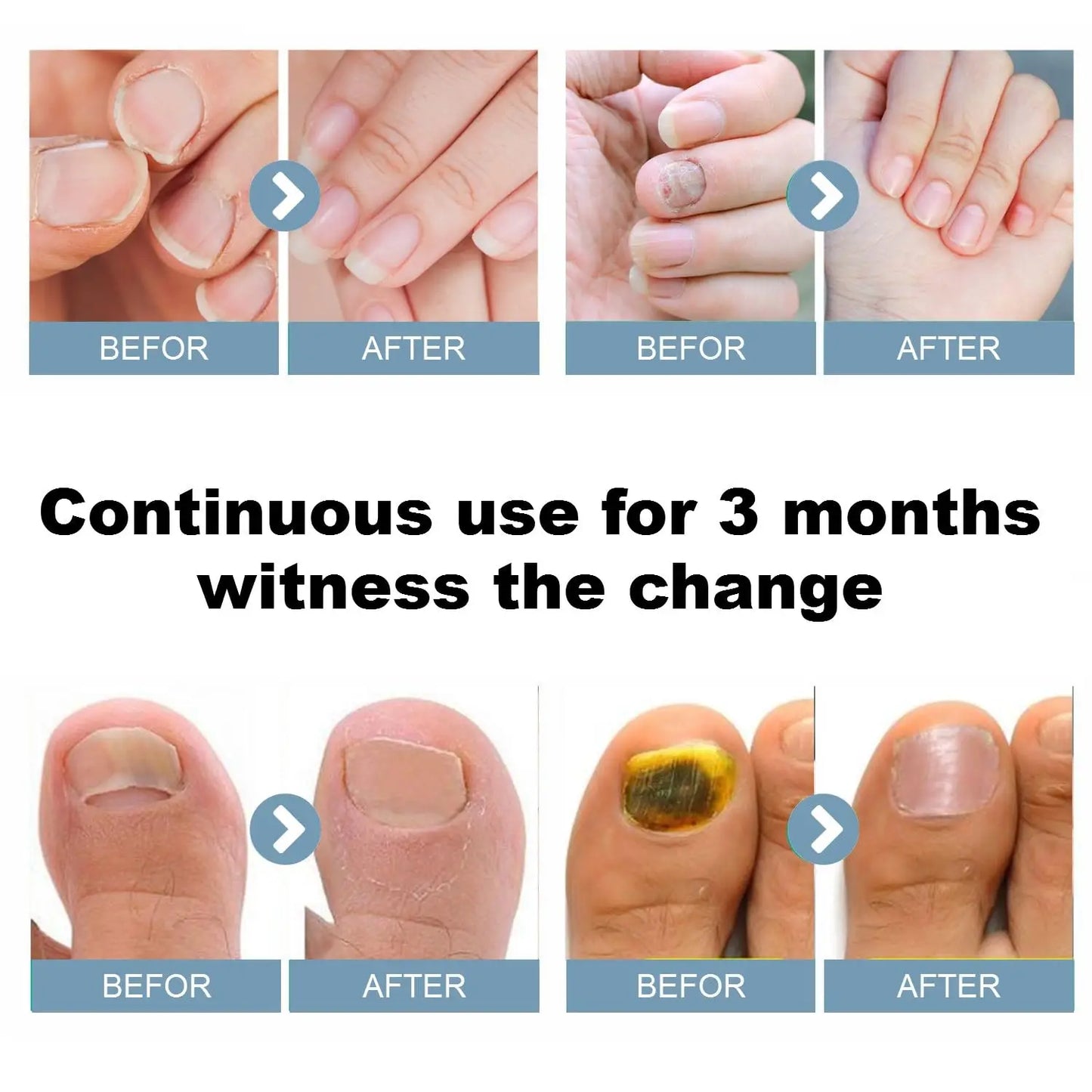 Nail Fungus Cleaning Light Device for Onychomycosis USB Charge 905nm Infrared Light 470nm Blue Light NailSalon Nail Fungus Laser